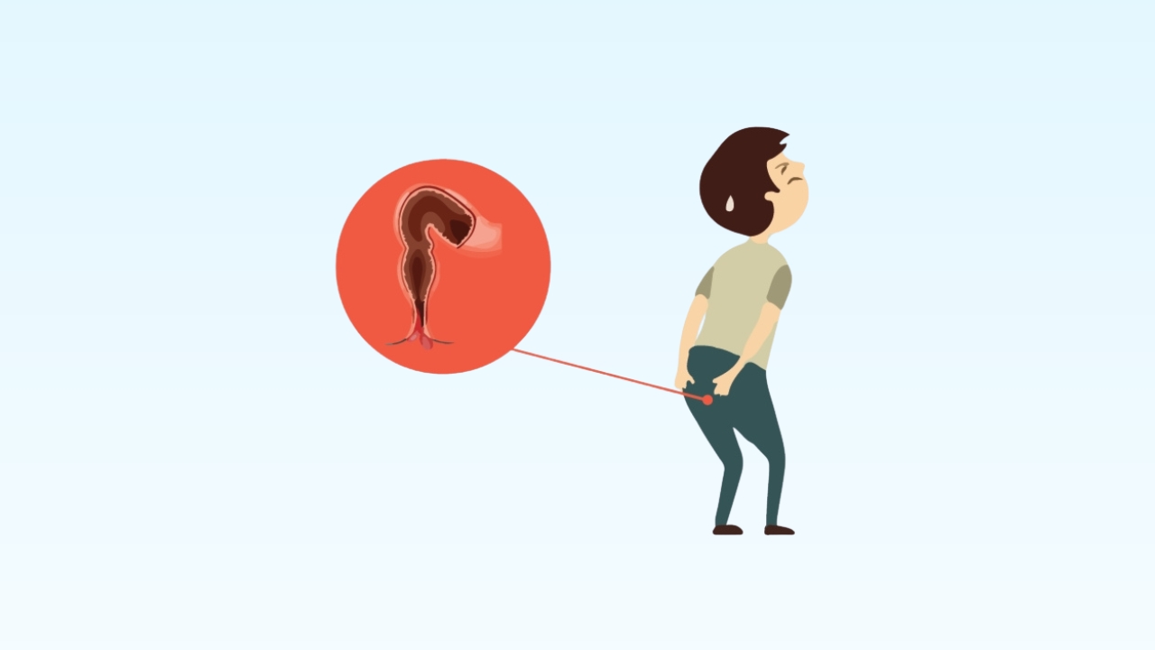 Rectal Prolapse Diagnosis and Treatment